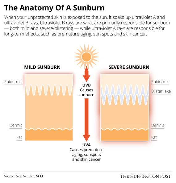 Cosa succede alla tua pelle quando bruci al sole?